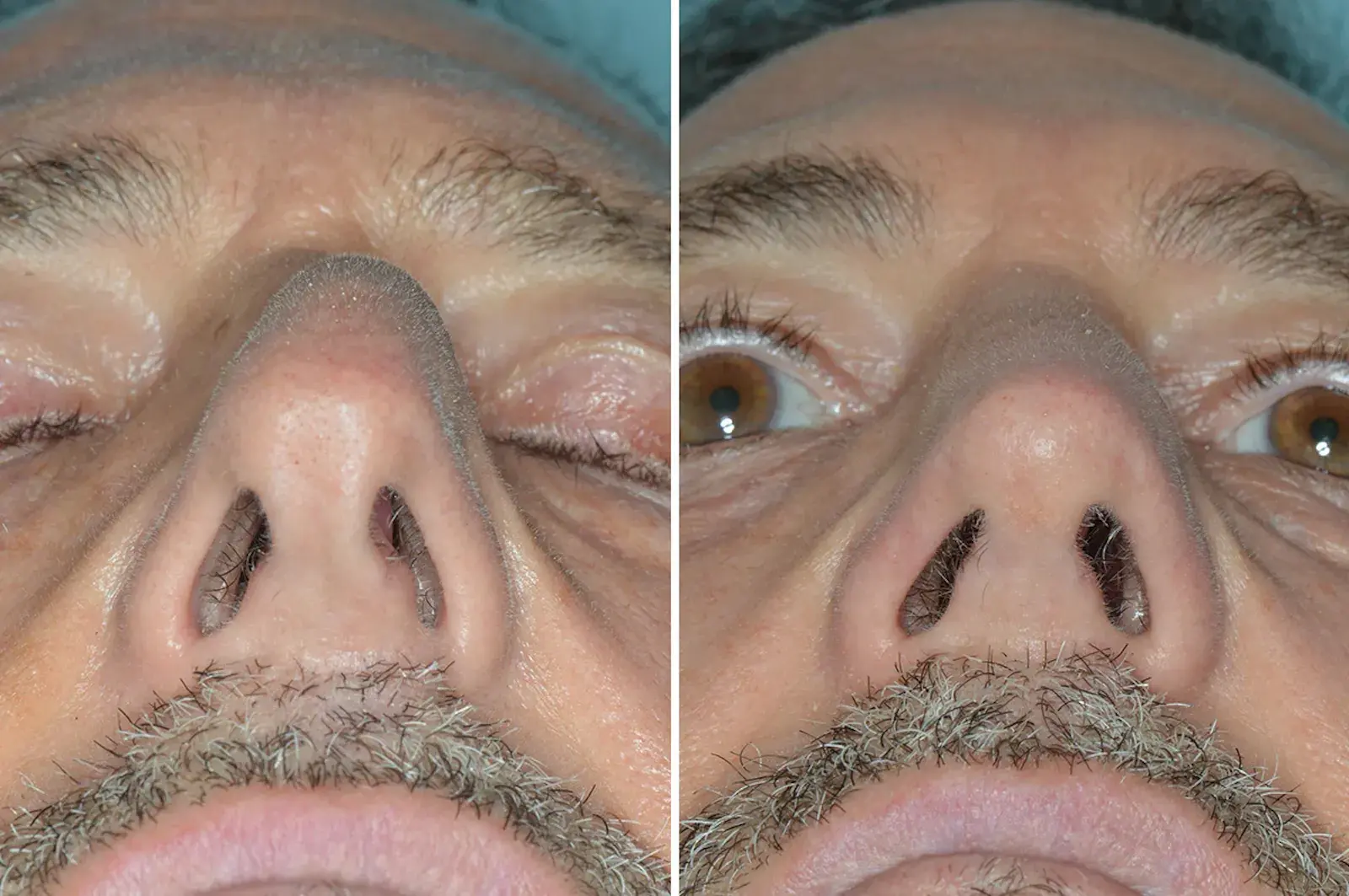 Dr. Anthony Bared Facial Plastic Surgery rhinoplasty result — Miami, FL