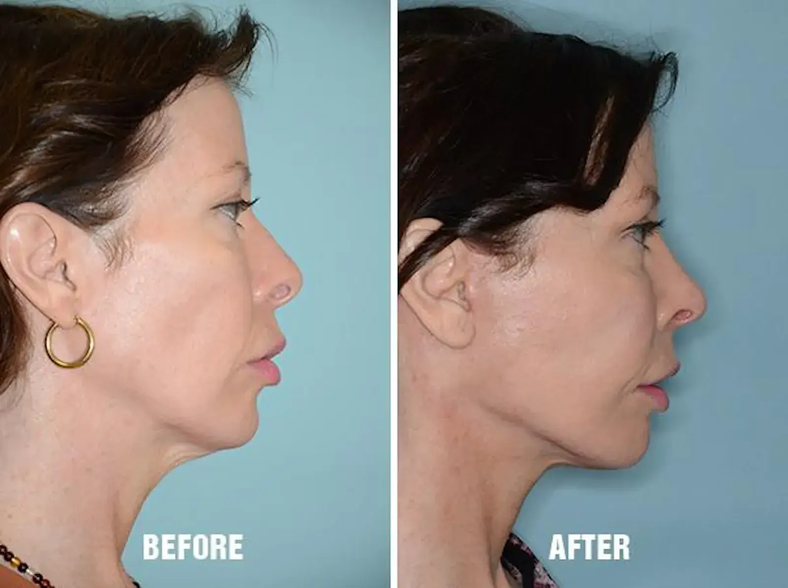 Dr. Anthony Bared Facial Plastic Surgery blepharoplasty result — Miami, FL