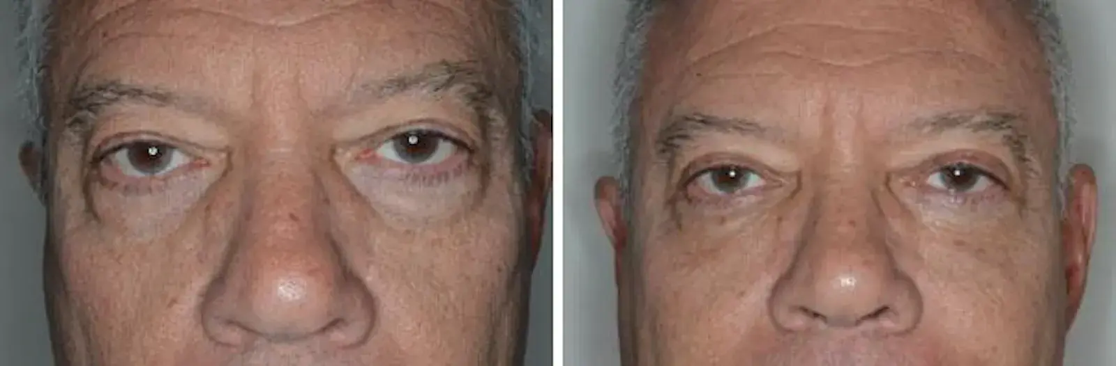 Dr. Anthony Bared Facial Plastic Surgery blepharoplasty result — Miami, FL