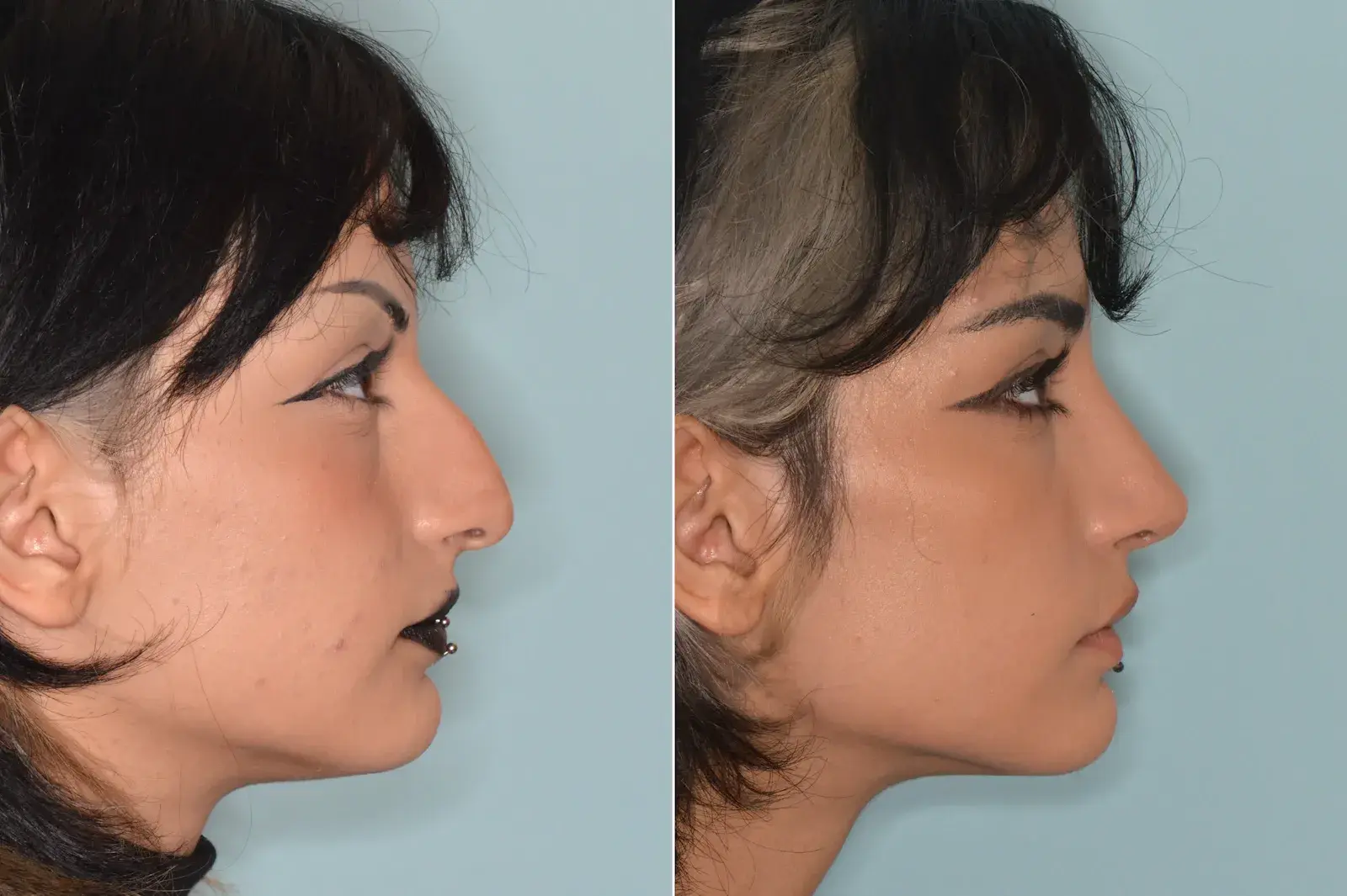 Dr. Anthony Bared Facial Plastic Surgery rhinoplasty result — Miami, FL