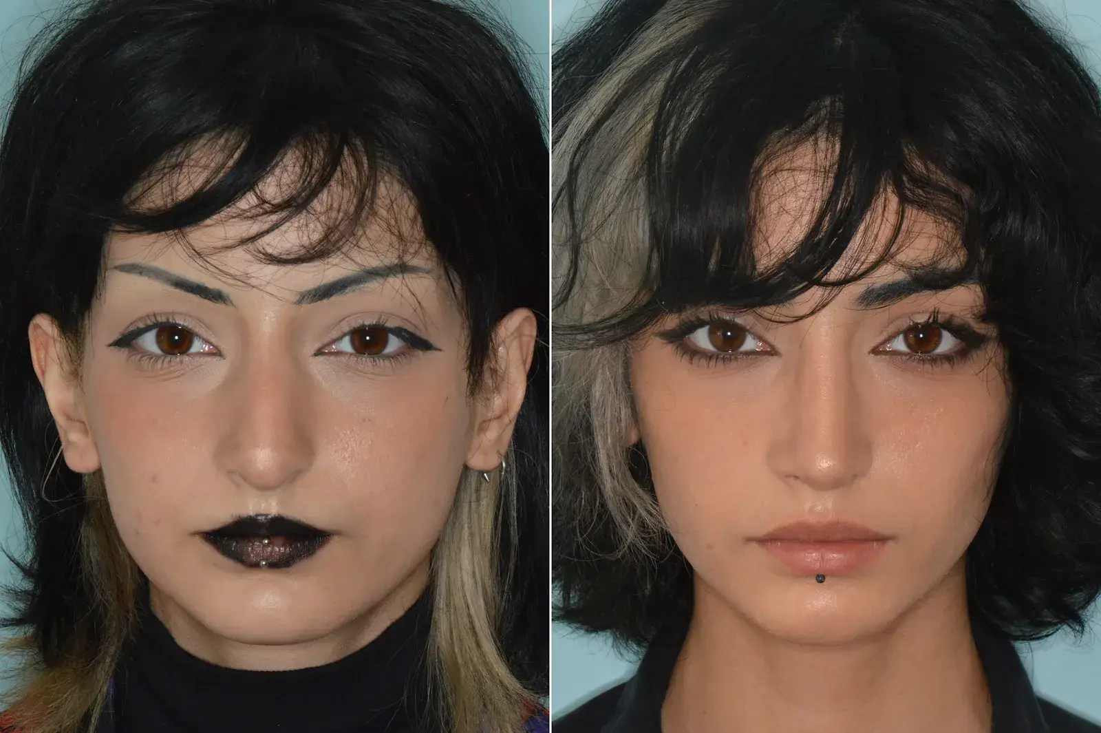 Dr. Anthony Bared Facial Plastic Surgery rhinoplasty result — Miami, FL