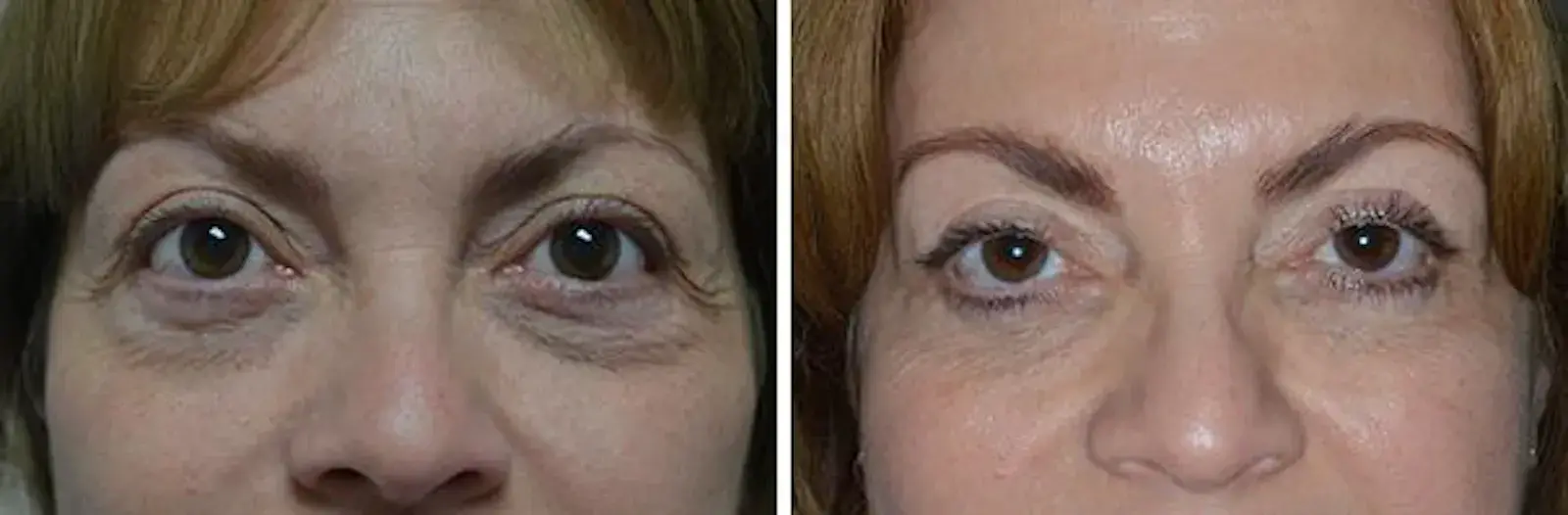 Dr. Anthony Bared Facial Plastic Surgery blepharoplasty result — Miami, FL