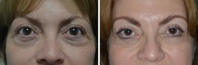 Blepharoplasty result at Dr. Anthony Bared Facial Plastic Surgery in Miami, FL