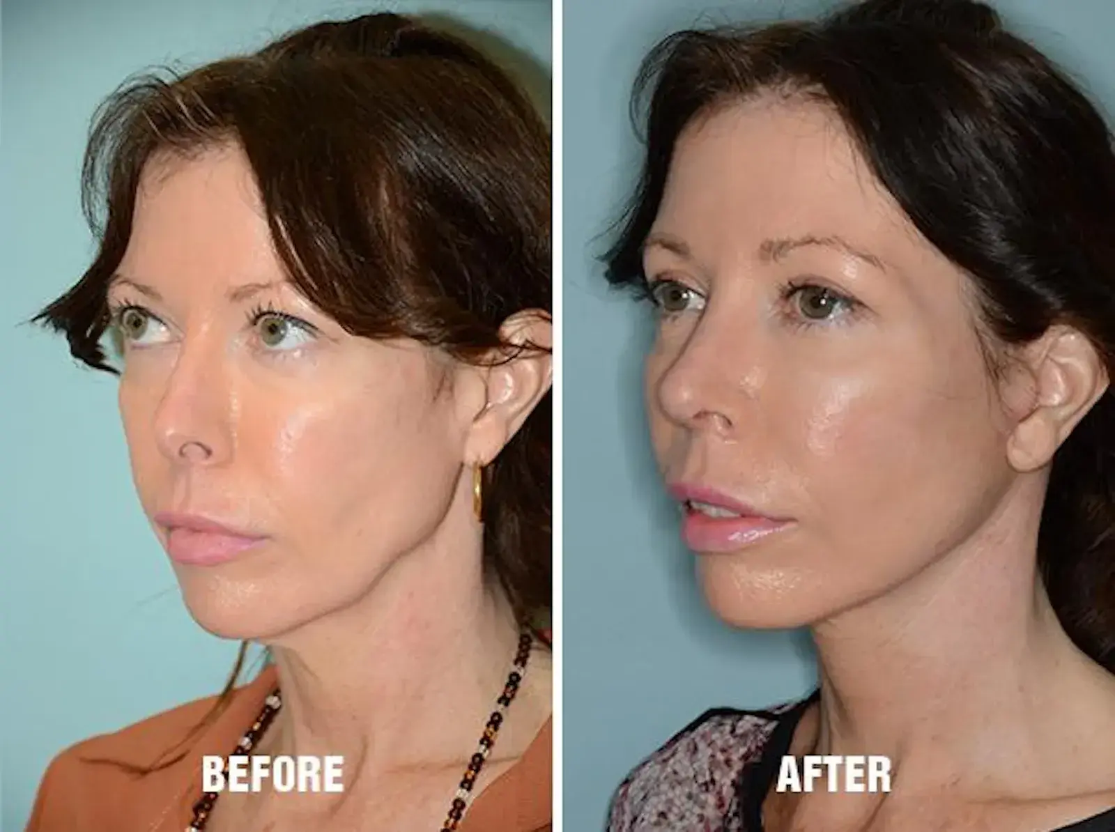 Dr. Anthony Bared Facial Plastic Surgery blepharoplasty result — Miami, FL