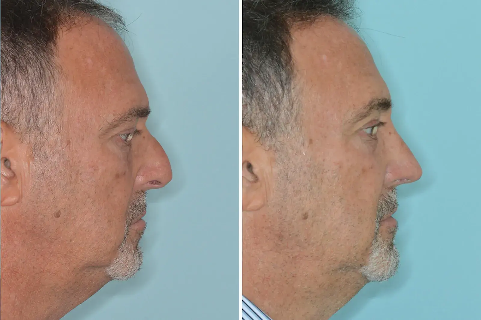 Dr. Anthony Bared Facial Plastic Surgery rhinoplasty result — Miami, FL