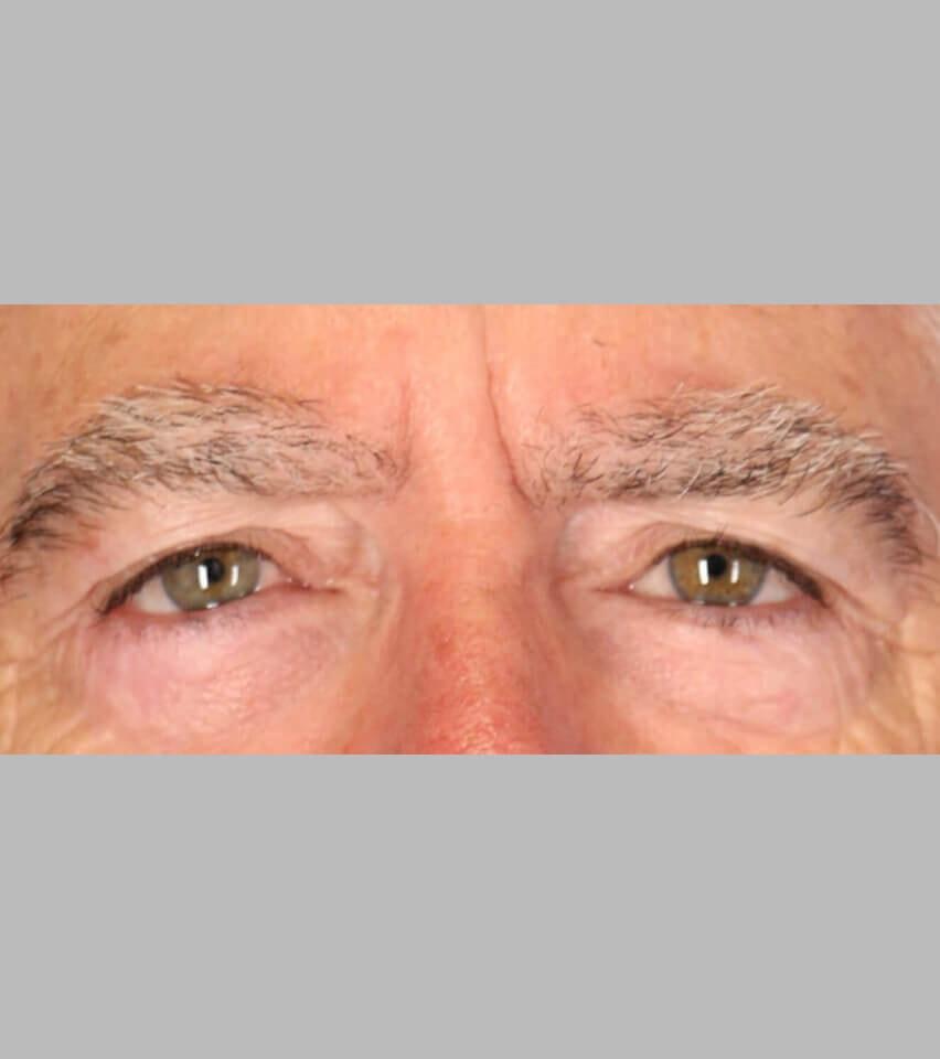 Sarmela Sunder, MD eyelid lift after — Beverly Hills, CA