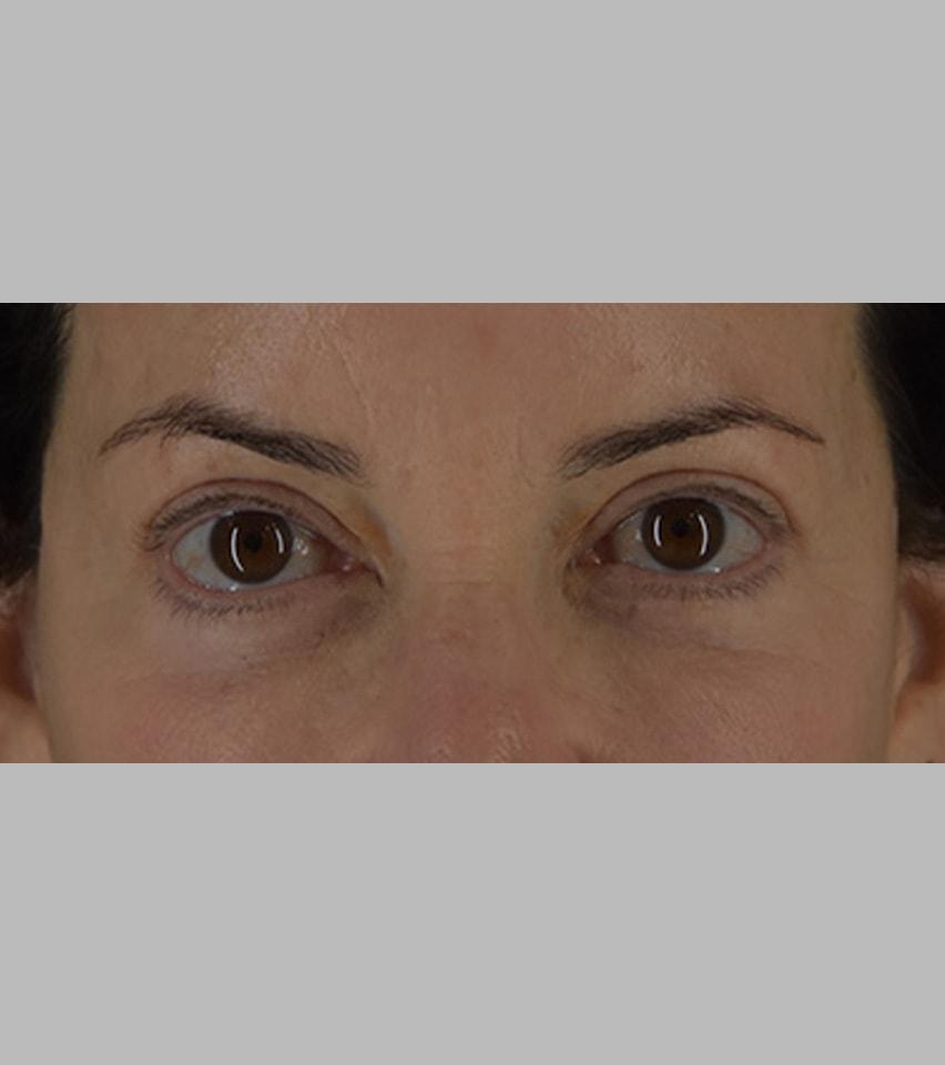 Sarmela Sunder, MD eyelid lift after — Beverly Hills, CA