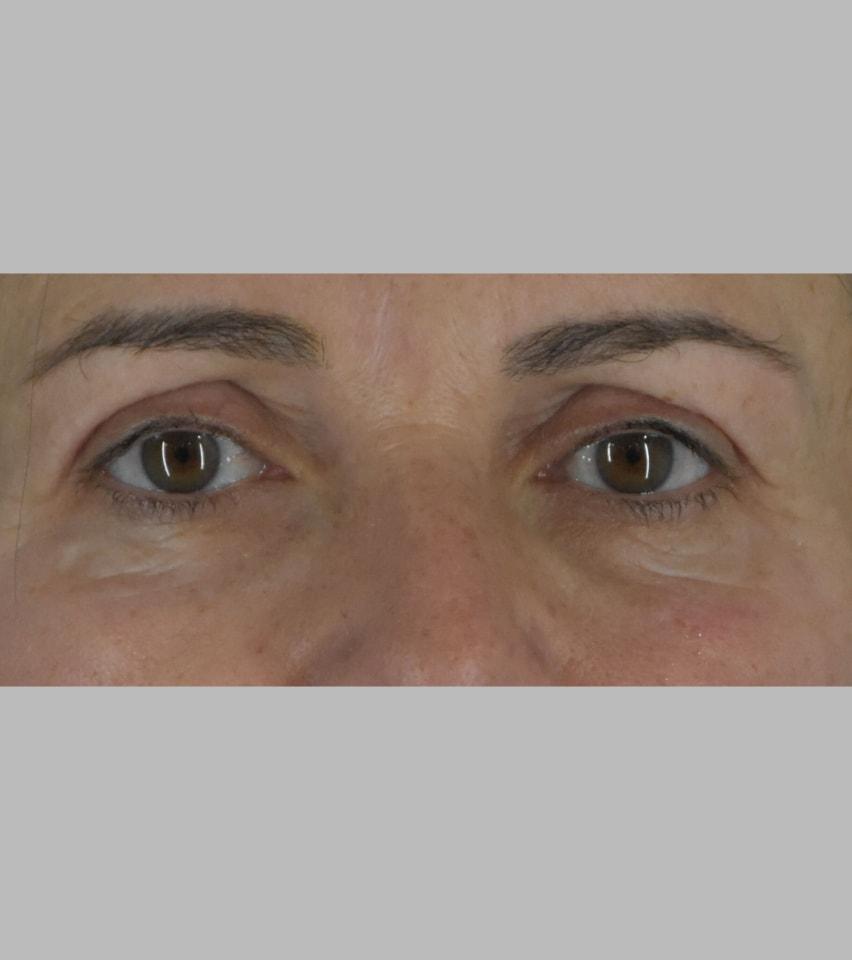 Sarmela Sunder, MD eyelid lift after — Beverly Hills, CA