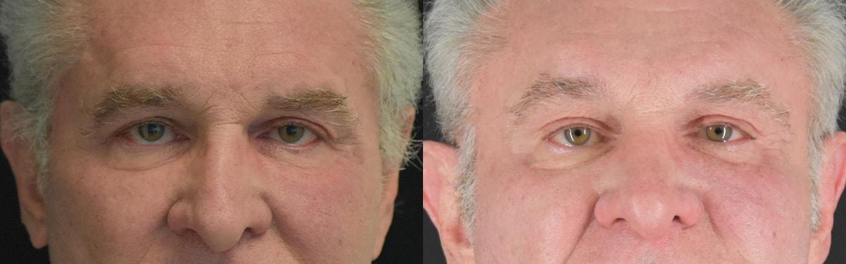 Sarmela Sunder, MD brow lift result — Beverly Hills, CA