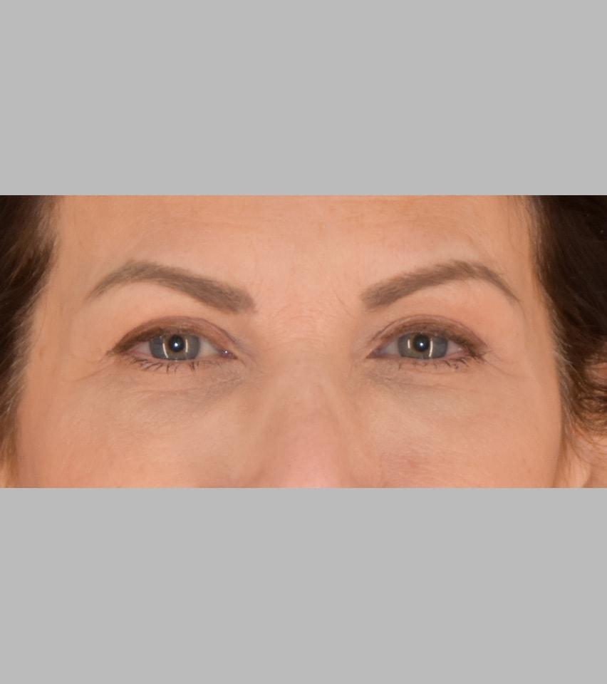 Sarmela Sunder, MD eyelid lift after — Beverly Hills, CA