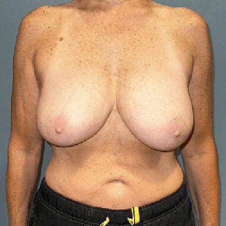 Breast Reduction before at Aesthetic Surgery Centre and Medical Spa in Tacoma, WA