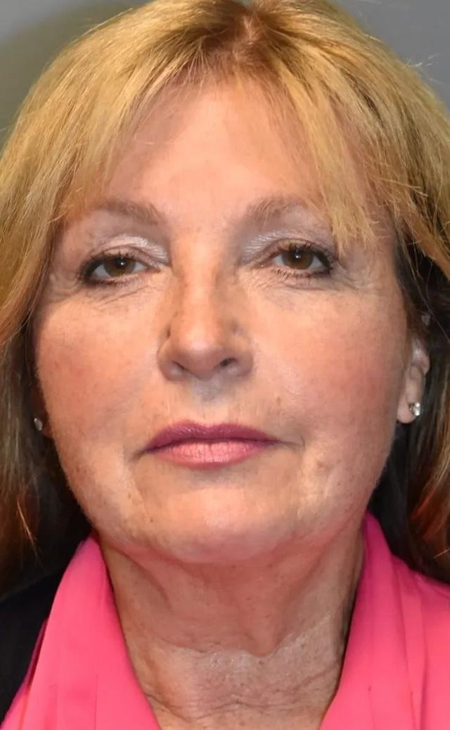 Deep Plane Facelift before at Aesthetic Surgery Centre and Medical Spa in Tacoma, WA