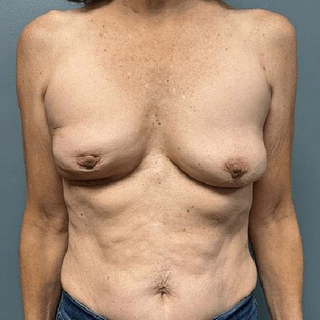 Breast Reduction after at Aesthetic Surgery Centre and Medical Spa in Tacoma, WA