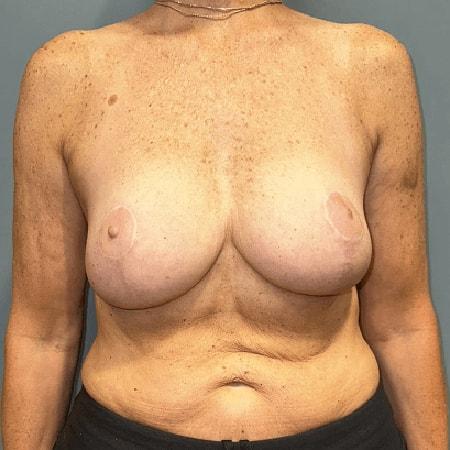 Breast Reduction after at Aesthetic Surgery Centre and Medical Spa in Tacoma, WA