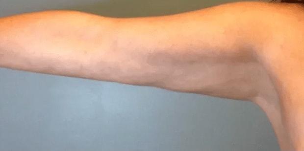 Aesthetic Surgery Centre and Medical Spa fat freezing after — Tacoma, WA