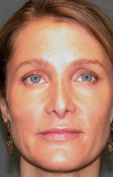Rhinoplasty after at Aesthetic Surgery Centre and Medical Spa in Tacoma, WA