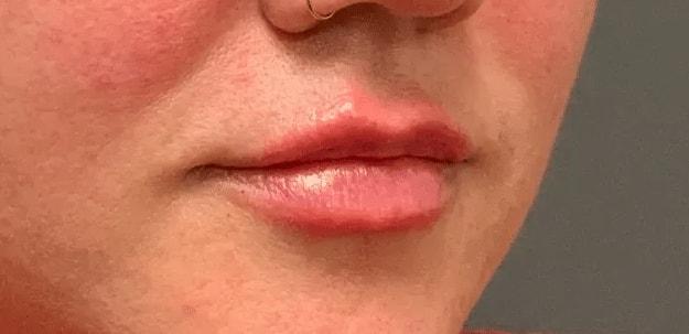 Lip Filler after at Aesthetic Surgery Centre and Medical Spa in Tacoma, WA