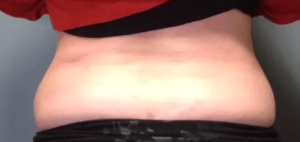 Aesthetic Surgery Centre and Medical Spa fat freezing after — Tacoma, WA