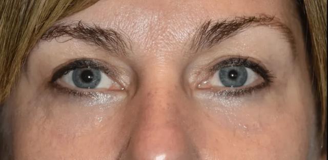 Blepharoplasty after at Aesthetic Surgery Centre and Medical Spa in Tacoma, WA