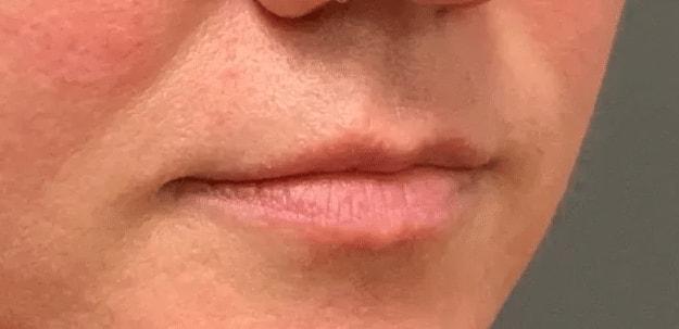 Lip Filler before at Aesthetic Surgery Centre and Medical Spa in Tacoma, WA
