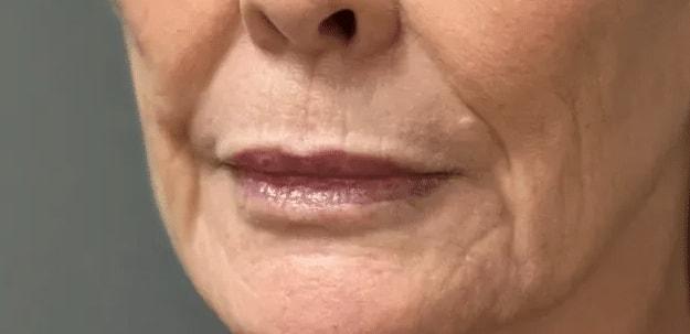 Lip Filler after at Aesthetic Surgery Centre and Medical Spa in Tacoma, WA