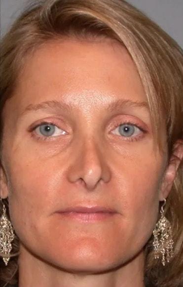 Rhinoplasty before at Aesthetic Surgery Centre and Medical Spa in Tacoma, WA