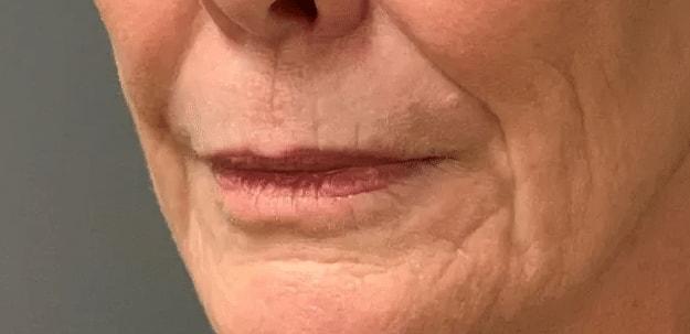 Lip Filler before at Aesthetic Surgery Centre and Medical Spa in Tacoma, WA