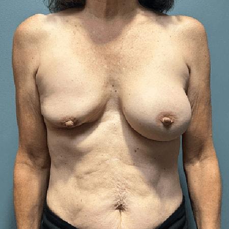 Breast Reduction before at Aesthetic Surgery Centre and Medical Spa in Tacoma, WA