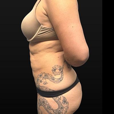 Liposuction after at Aesthetic Surgery Centre and Medical Spa in Tacoma, WA
