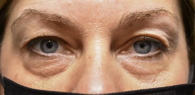 Blepharoplasty before at Aesthetic Surgery Centre and Medical Spa in Tacoma, WA