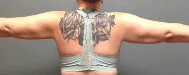 Aesthetic Surgery Centre and Medical Spa fat freezing after — Tacoma, WA