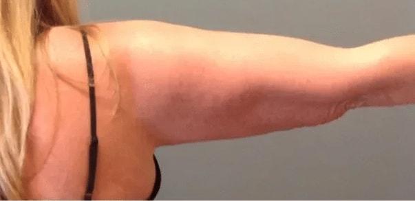 Aesthetic Surgery Centre and Medical Spa fat freezing after — Tacoma, WA