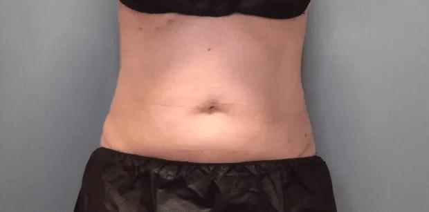 Aesthetic Surgery Centre and Medical Spa fat freezing after — Tacoma, WA