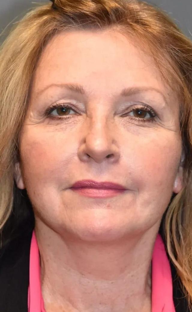 Deep Plane Facelift after at Aesthetic Surgery Centre and Medical Spa in Tacoma, WA