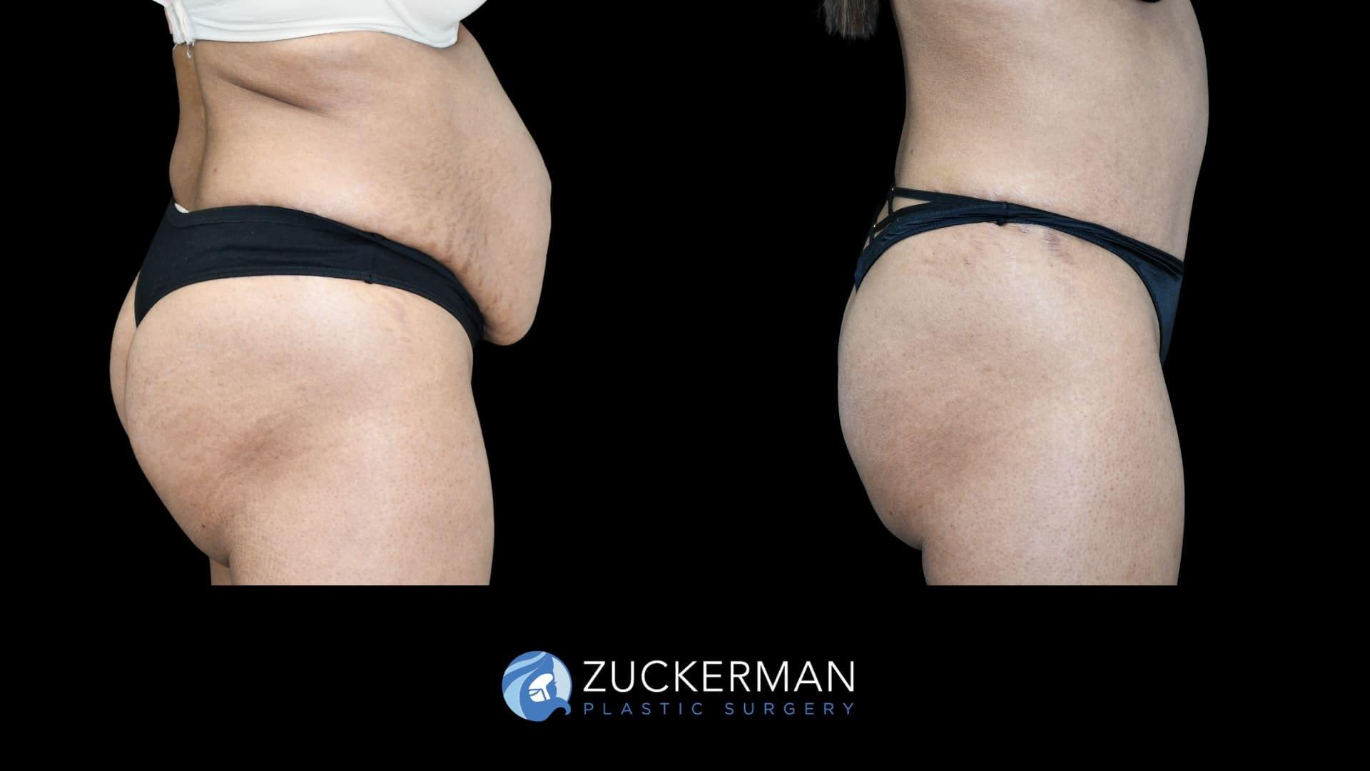 Zuckerman Plastic Surgery tummy tuck result — New York, NY