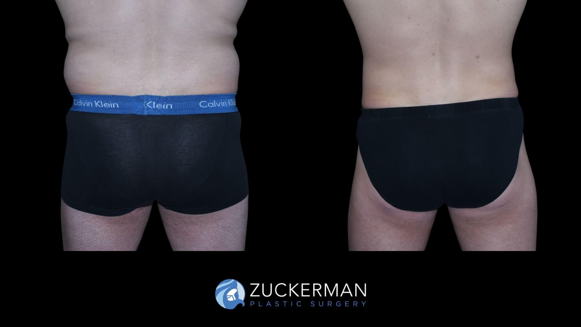 Zuckerman Plastic Surgery bbl result — New York, NY
