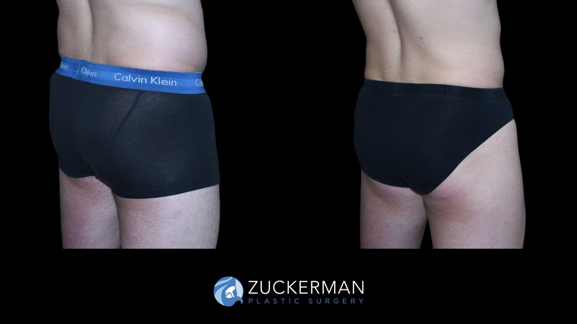 Zuckerman Plastic Surgery bbl result — New York, NY