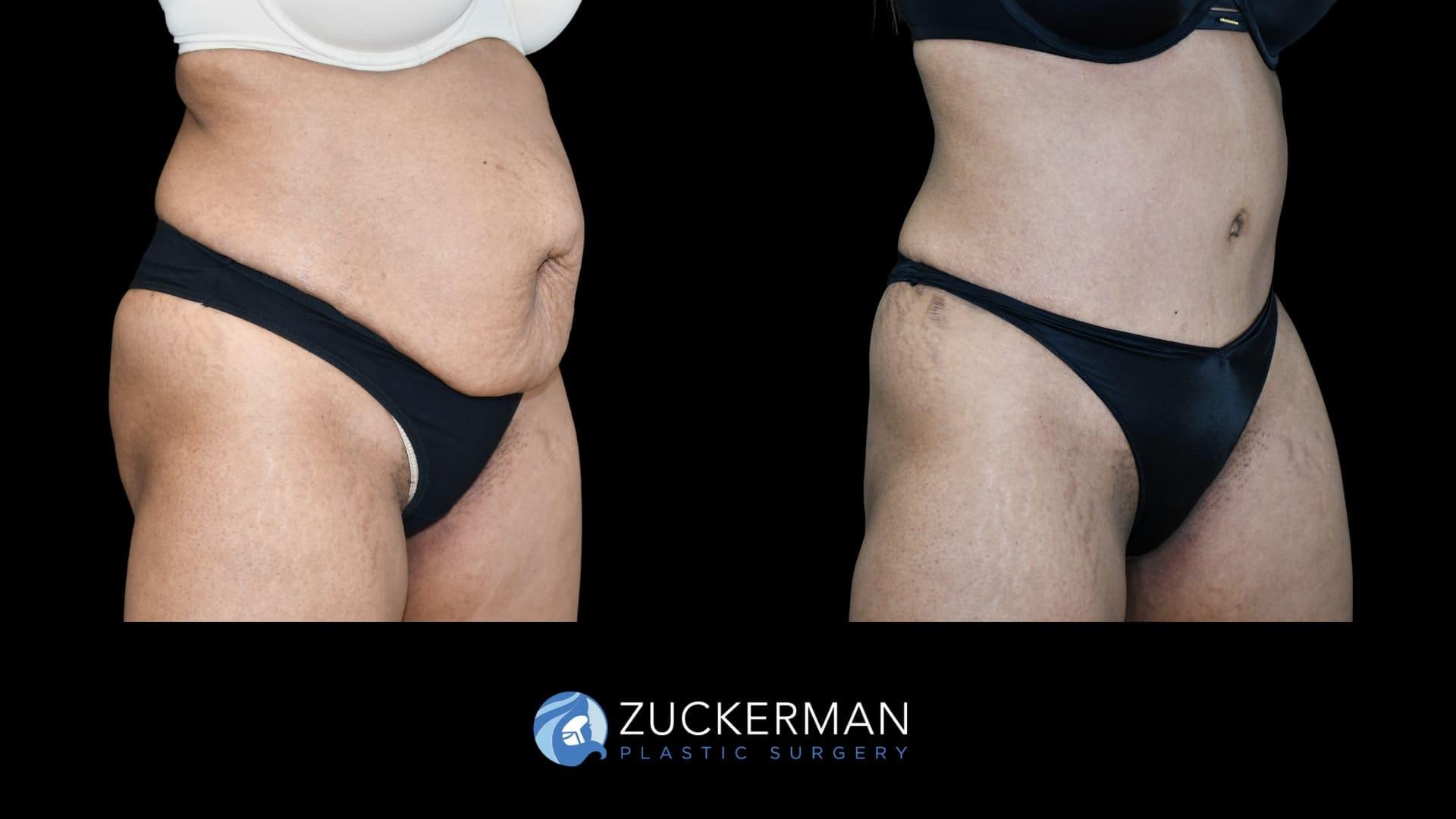 Zuckerman Plastic Surgery tummy tuck result — New York, NY
