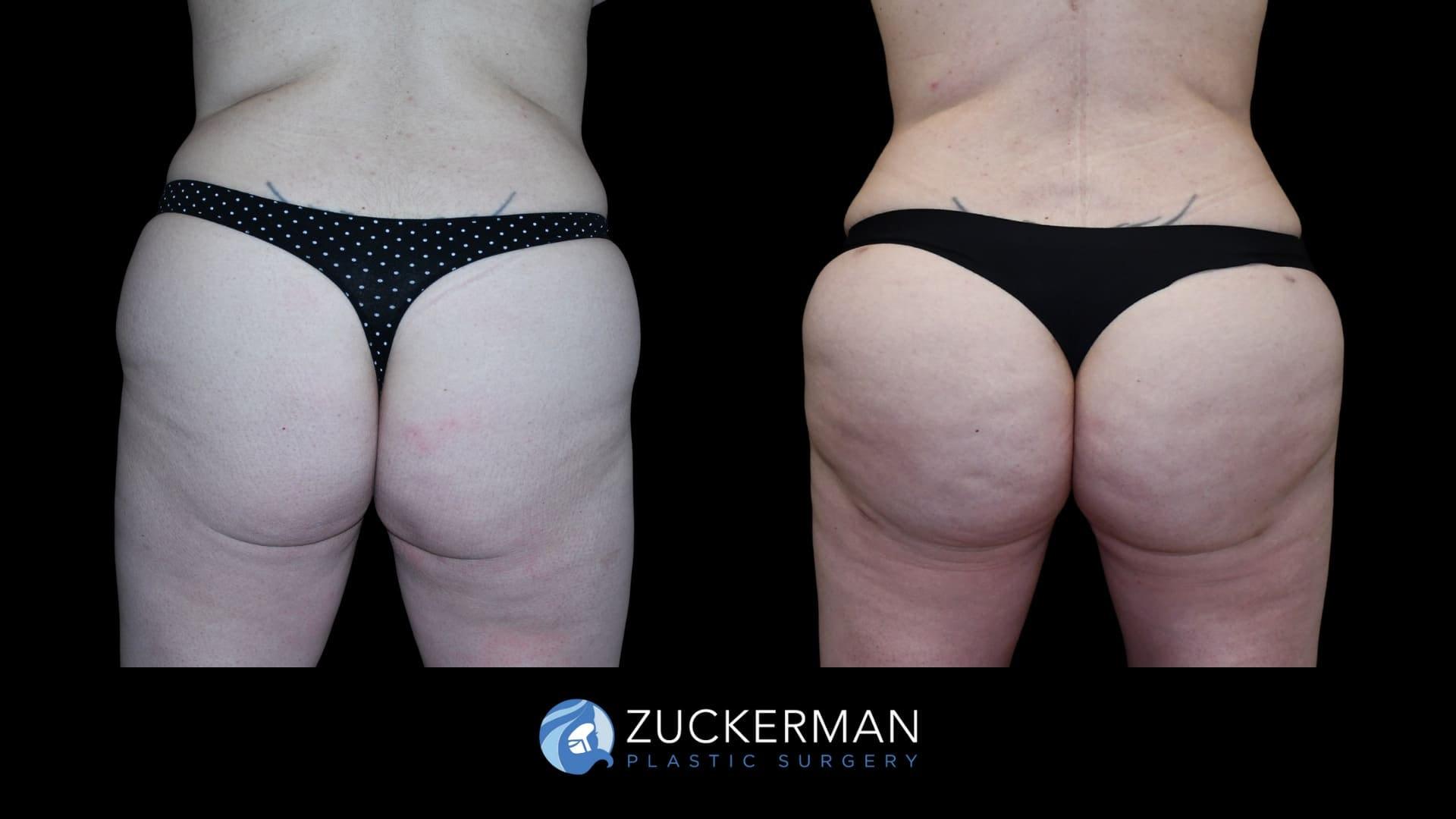 Zuckerman Plastic Surgery bbl result — New York, NY