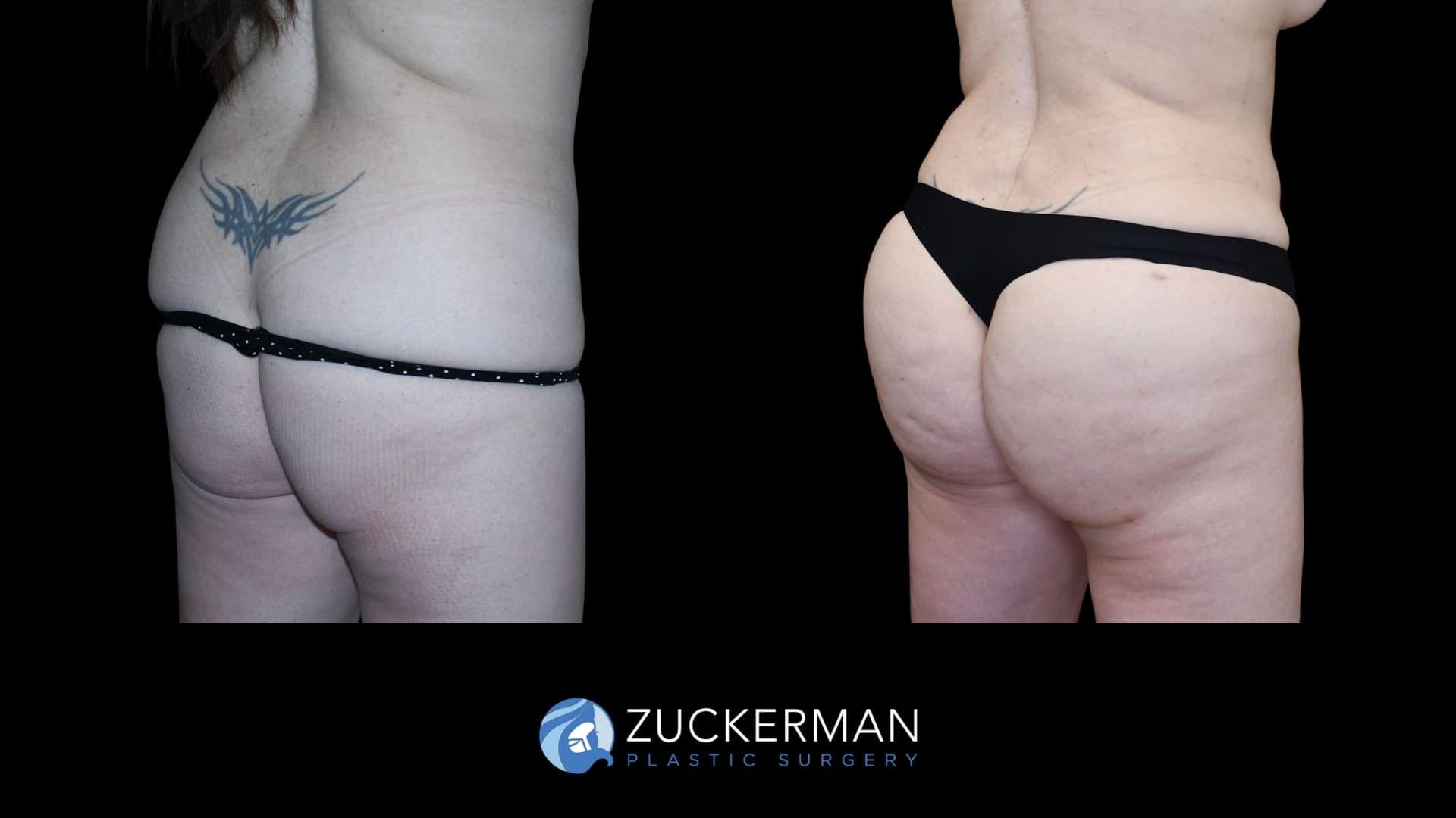 Zuckerman Plastic Surgery bbl result — New York, NY