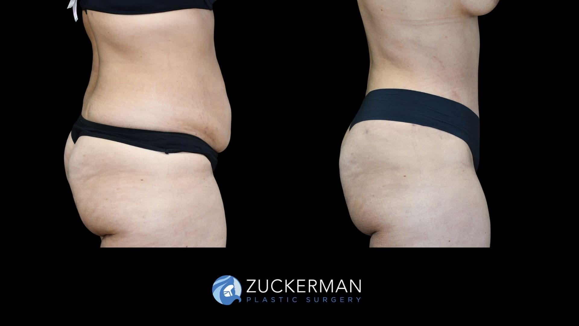 Zuckerman Plastic Surgery tummy tuck result — New York, NY