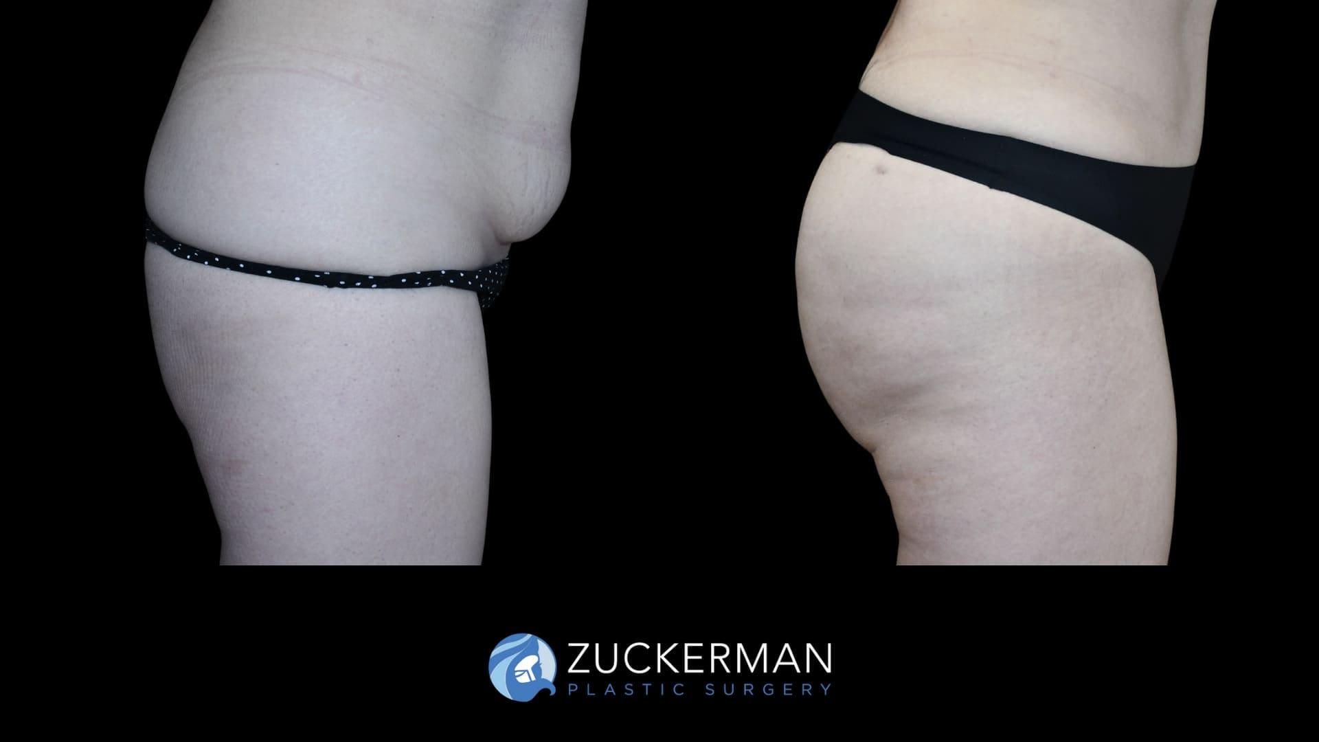 Zuckerman Plastic Surgery tummy tuck result — New York, NY