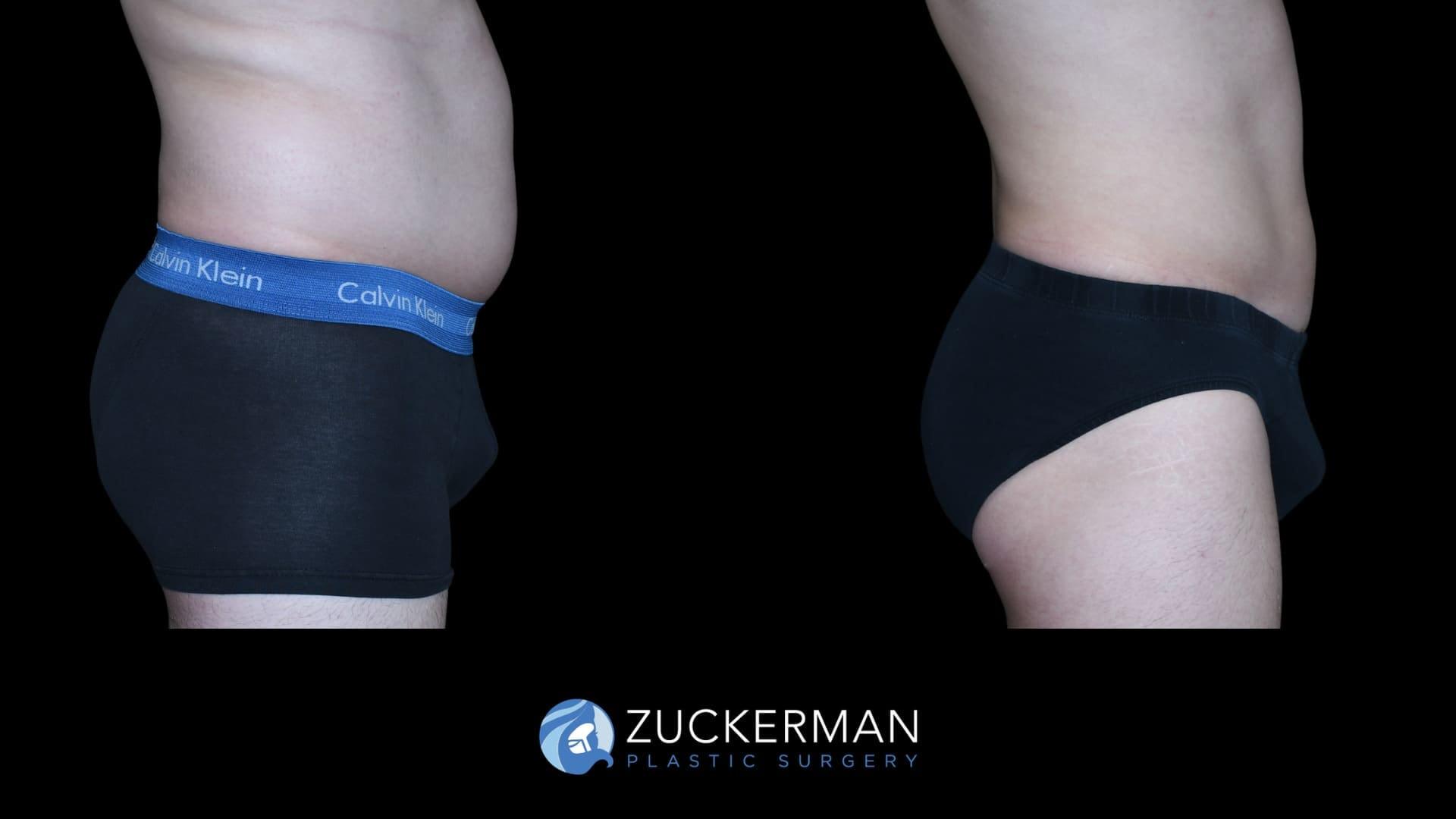 Zuckerman Plastic Surgery bbl result — New York, NY