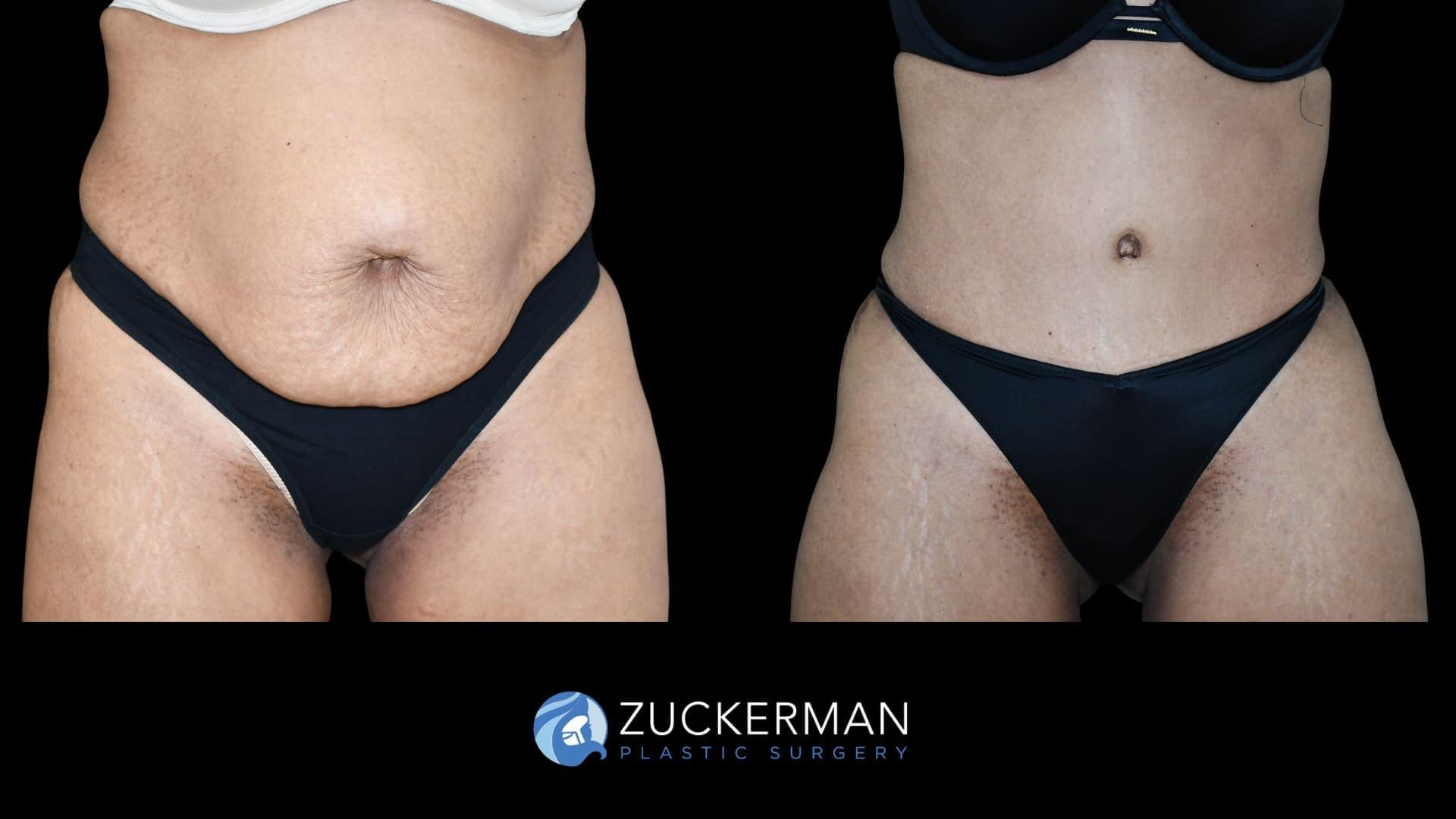 Zuckerman Plastic Surgery tummy tuck result — New York, NY