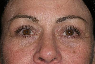 David S. Felder, MD eyelid lift after — Fort Lauderdale, FL