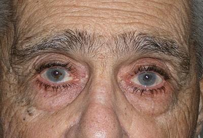 David S. Felder, MD eyelid lift after — Fort Lauderdale, FL