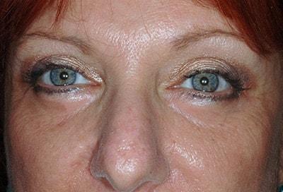 David S. Felder, MD eyelid lift after — Fort Lauderdale, FL
