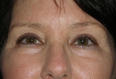 David S. Felder, MD eyelid lift after — Fort Lauderdale, FL