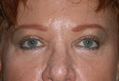 David S. Felder, MD eyelid lift after — Fort Lauderdale, FL