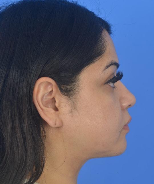 Facial Plastic Surgery Associates neck liposuction after — Houston, TX
